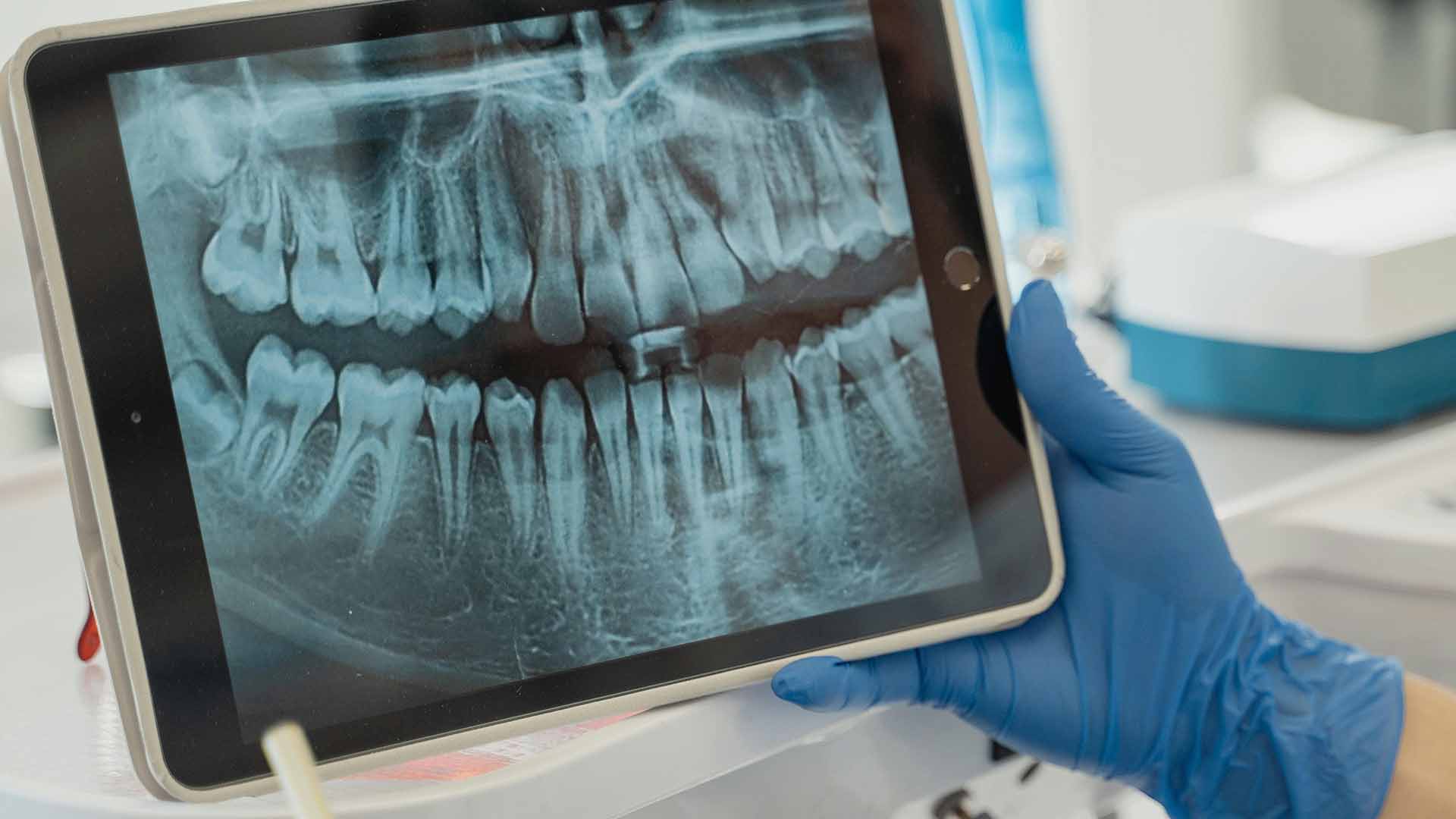 when is it too late to get dental implants