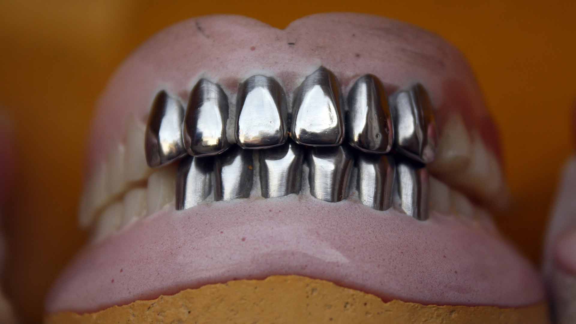 How Much Do Porcelain Veneers Cost? A Comprehensive Guide