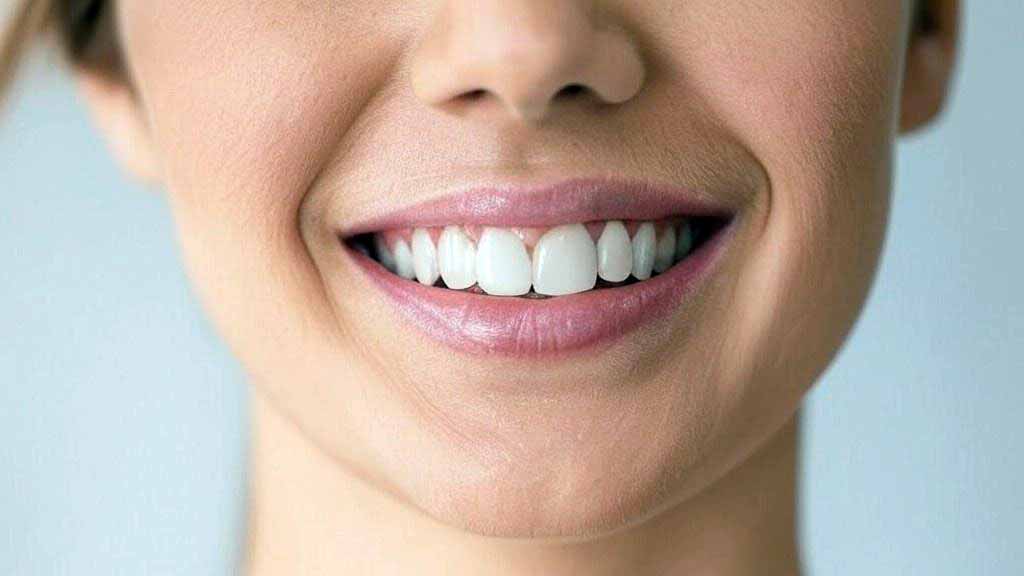 cost of porcelain veneers