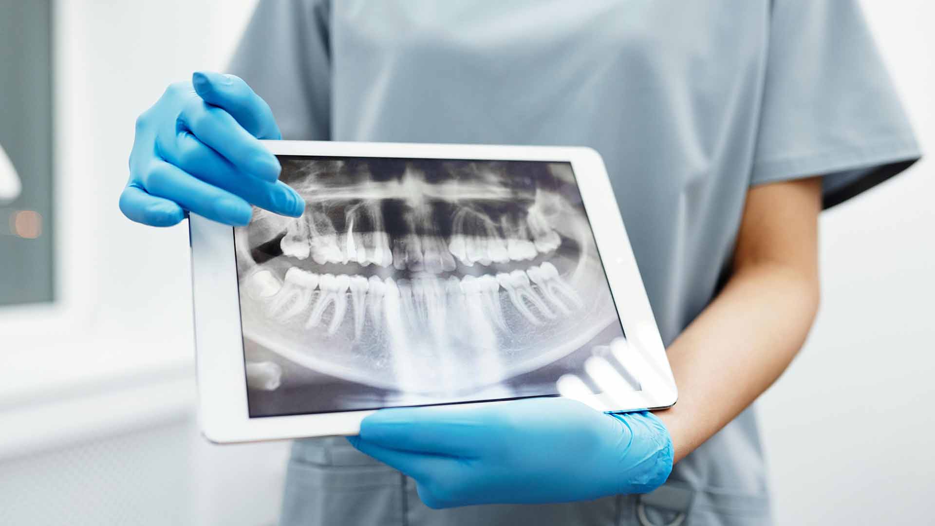 how much does a root canal cost without insurance